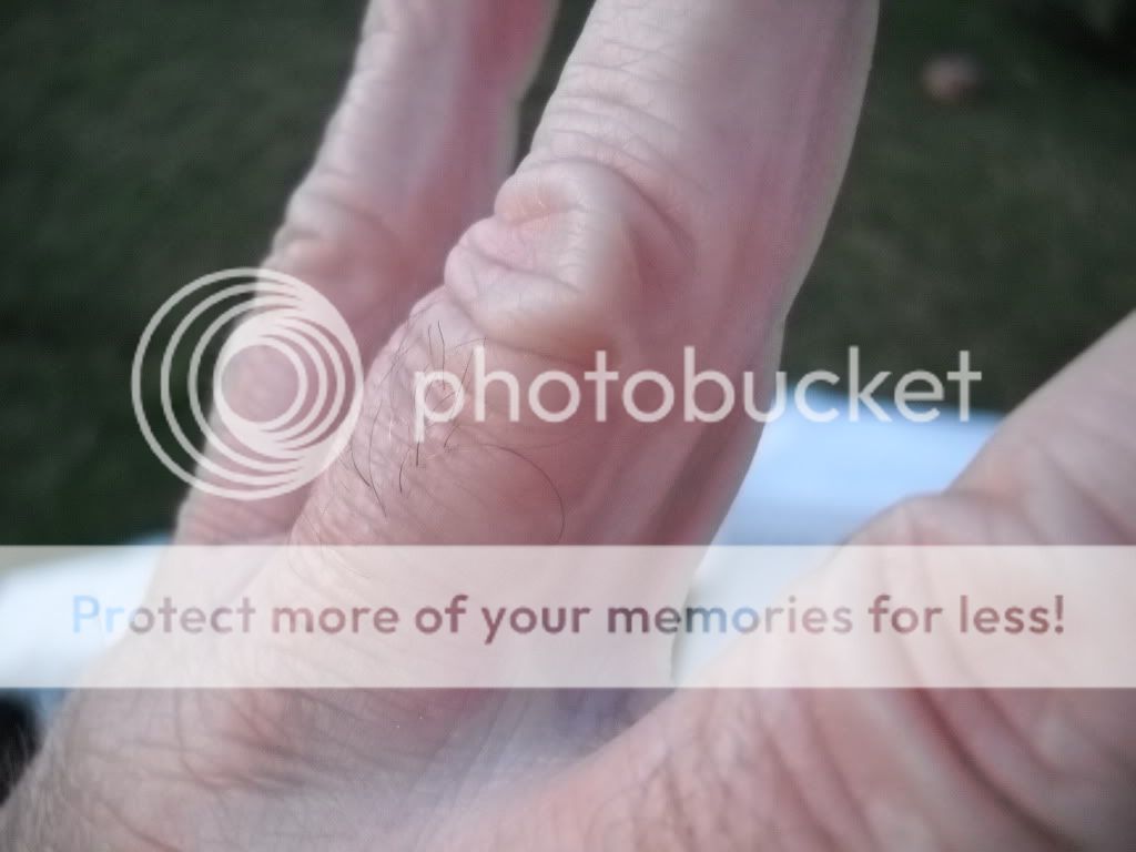 A new casting hazard